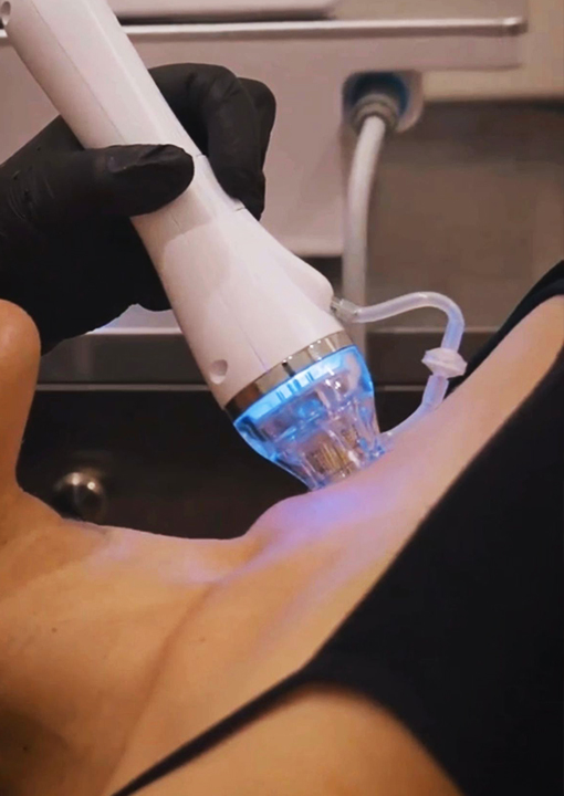 Radiofrequency Skin Needling